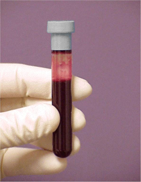 DUI Blood Testing Whole Blood
