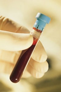 Hiring a Pennsylvania DUI lawyer with knowledge in blood testing is vital to the outcome of your case.